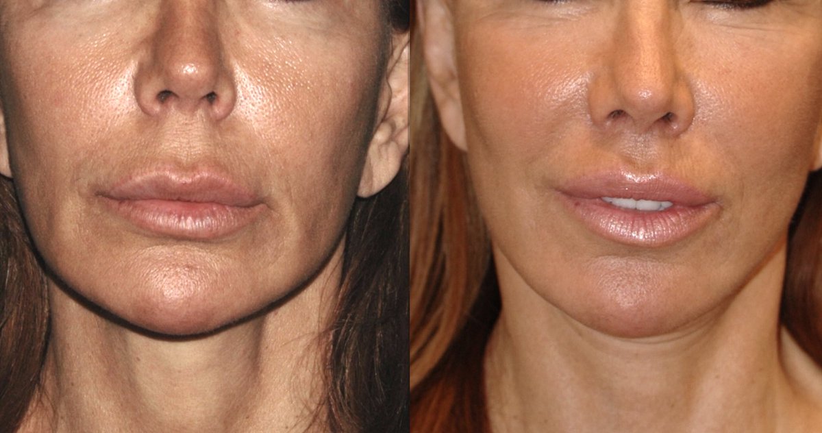 DrJacono's tweet photo. #happy4thofjuly Here is a 🎉#plasticsurgerybeforeandafter that I love of a #liplift patient of mine. #upperliplift #lips #lip #plasticsurgery #plasticsurgeon #plasticsurgerynyc #plasticsurgeonnyc #modifiedupperliplift #sexylips #lusciouslips #lipfiller #beauty #bestliplift https://t.co/18NLukcfhi