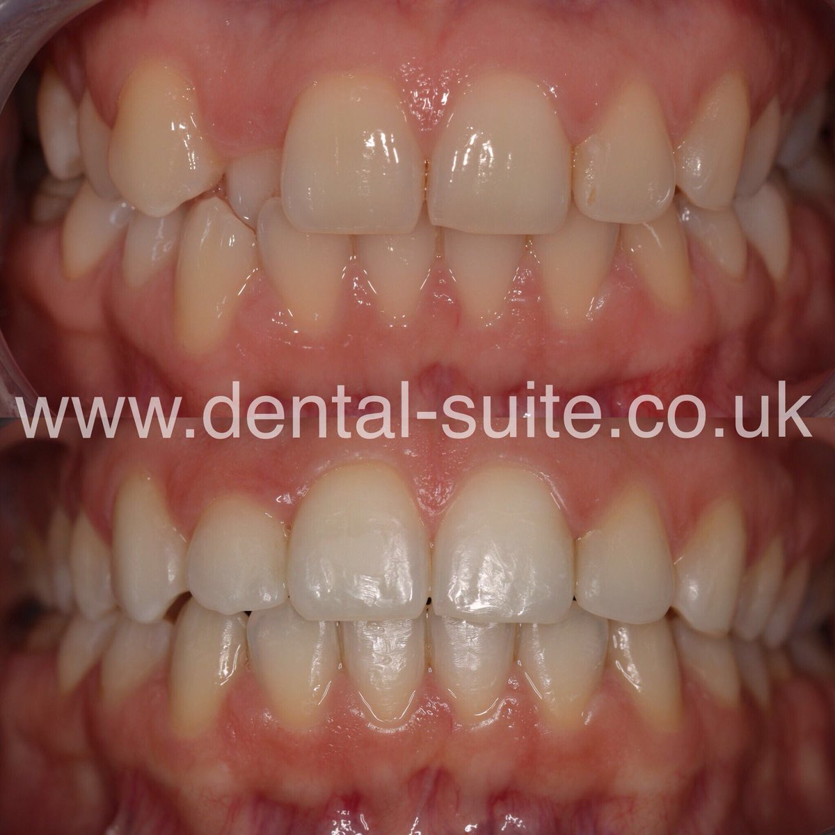 samedayteeth_s's tweet photo. A fantastic result with 6 month braces by Dr Anna Markomanolaki #6mb #results #smile #cosmetic #straight #teeth #white #happy #newsmile #dental #ortho #braces #confidence #dentist #beauty #dentalsuite #loughborough #leicester #nottingham https://t.co/oHWL66kYN1