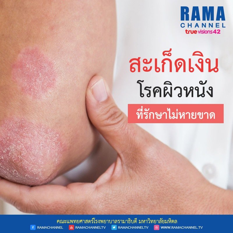 ramachanneltv's tweet photo. "สะเก็ดเงิน" โรคผิวหนัง ที่รักษาไม่หายขาด และทำให้ผู้ป่วยสูญเสียความมั่นใจ

📖 อ่านบทความ >> https://t.co/oUZF5SfieP

#Ramchannel #โรคผิวหนัง #โรคสะเก็ดเงิน https://t.co/lA9Kwl5zTf