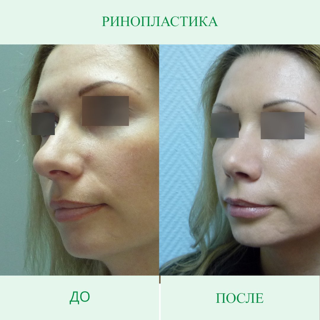 Хайбула ринопластика в Махачкале
