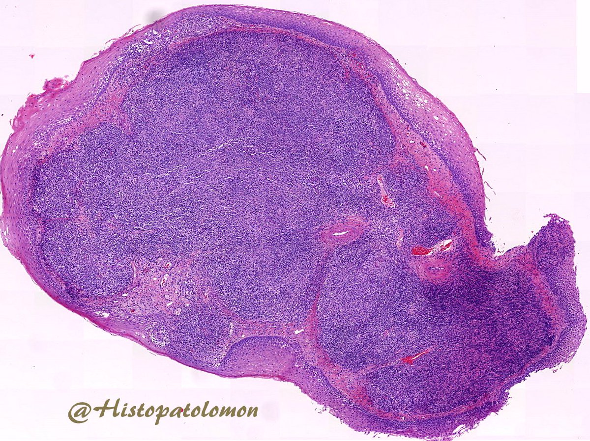 Histopatolomon's tweet photo. Larynx biopsy. What you think? #ENTPath #GIPath #pathology https://t.co/zRsq8dkpR8