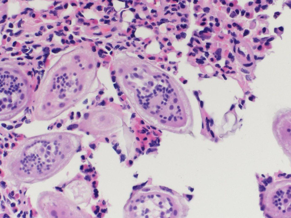 Bladder biopsy in a child with a history of prolonged travel to central Africa.  Presented with gross hematuria.  Any guesses on species?  #UroPath #PediPath