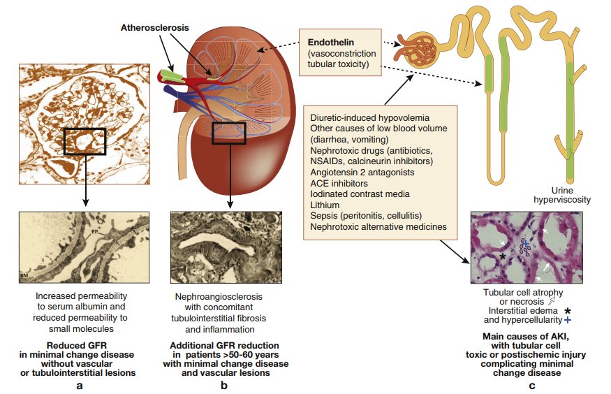 CureGN on Twitter: "Acute kidney injury complicating ...