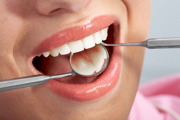 How Long Do Dental Crowns Last?
(ow.ly/lb3N30koDxO)

#dentalcrown #toothcrown #damagedtooth