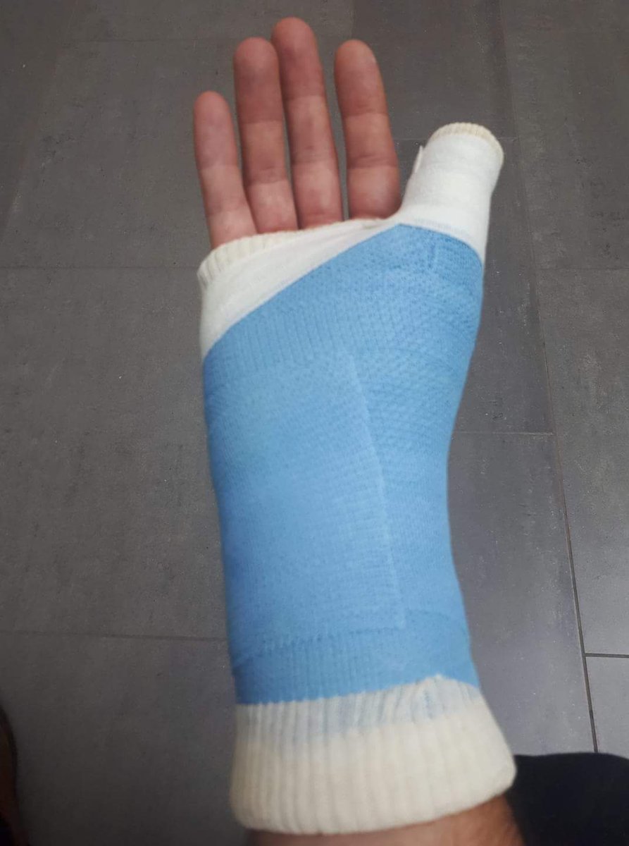 Socially_Rich's tweet photo. Hey there #BristolBizHour. Just dropping in to say I am nearly fixed and ready to host again soon!! Cast off and some kind of kinky hand bondage thing on!! #BustedHand #LearnToCatch #SpiderMonkeyFingers https://t.co/PUol1M5dCU