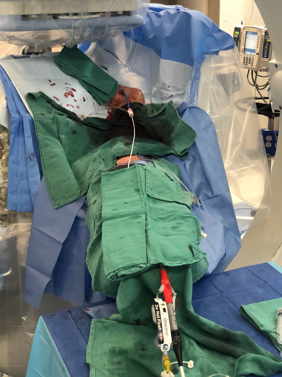 matheenkhuddus's tweet image. 72 y/o WM with AS and LM/MV CAD. Complex bilateral iliac disease. #PercAx for Impella CP. Right ulnar access for DK crush for LM disease with left #radialfirst access for management of left axillary artery. Big thanks to @DrAmirKaki for showing me how.