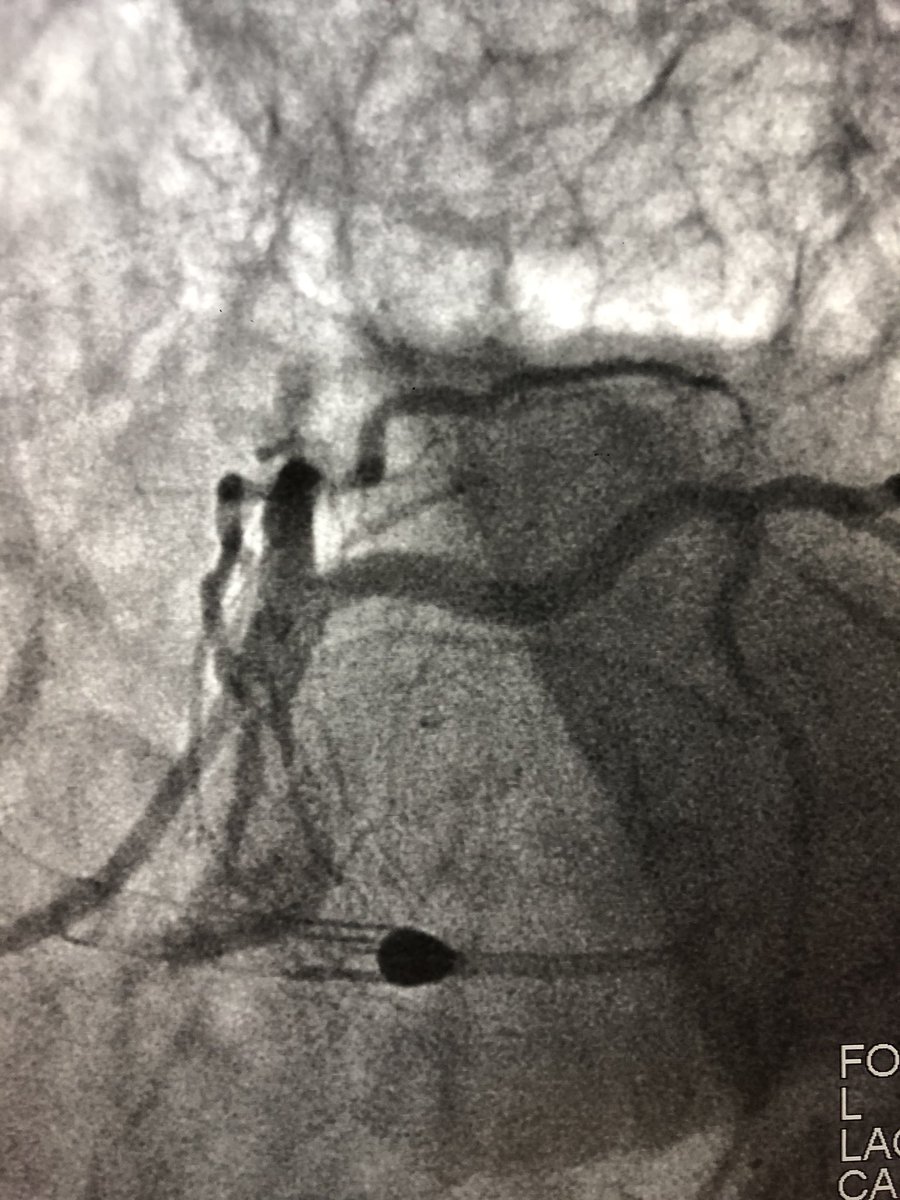 matheenkhuddus's tweet image. 72 y/o WM with AS and LM/MV CAD. Complex bilateral iliac disease. #PercAx for Impella CP. Right ulnar access for DK crush for LM disease with left #radialfirst access for management of left axillary artery. Big thanks to @DrAmirKaki for showing me how.