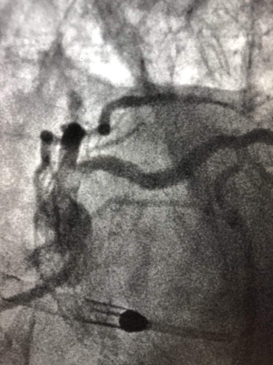 matheenkhuddus's tweet image. 72 y/o WM with AS and LM/MV CAD. Complex bilateral iliac disease. #PercAx for Impella CP. Right ulnar access for DK crush for LM disease with left #radialfirst access for management of left axillary artery. Big thanks to @DrAmirKaki for showing me how.
