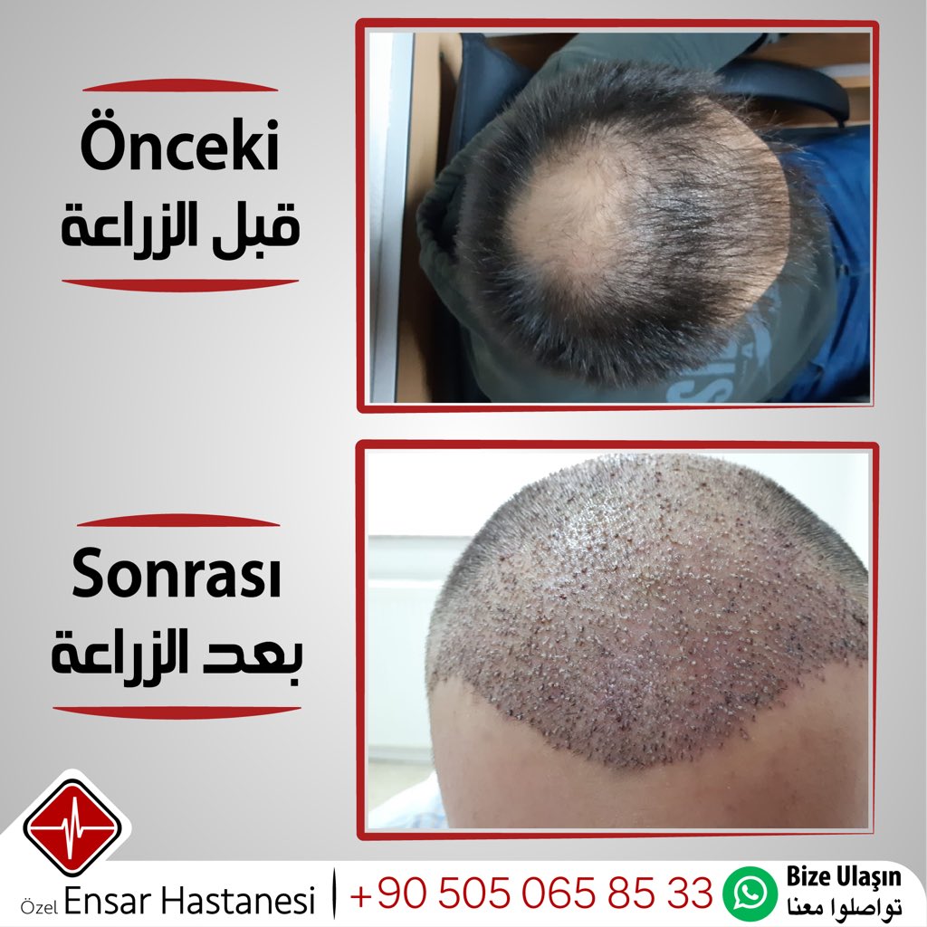 افضل النتائج وانسب الاسعار!
لمزيد من المعلومات تواصلوا معنا
00905050658533
#ensarhastanesi #saçekimi #fue #saç #istanbul #esenler #türkiye #زراعة_الشعر #زراعة_الشعر_في_تركيا #زراعة_الشعر_في_اسطنبول #زراعة_شعر #شعر #تركيا #اسطنبول #اسطنبول_تركيا #hairtransplant #hair #turkey