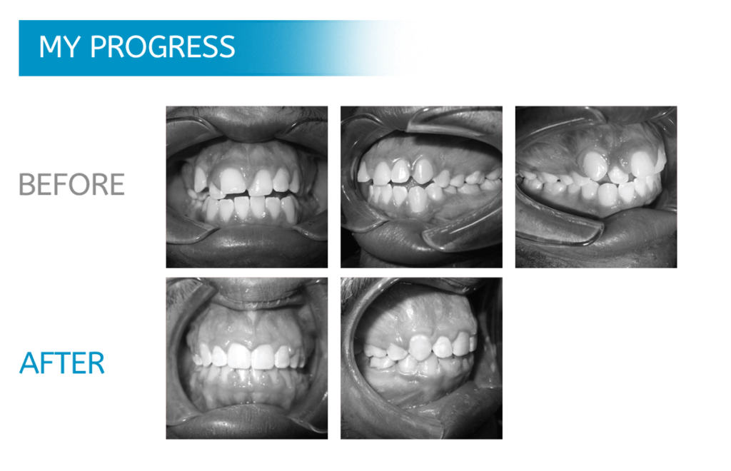 MidwestOrthodon's tweet photo. Brilliant smiles are our business. Our patients are our passion.
Find out more about Midwest Orthodontics @ https://t.co/JAUN7E3zAM! https://t.co/SvvxVH9EB2