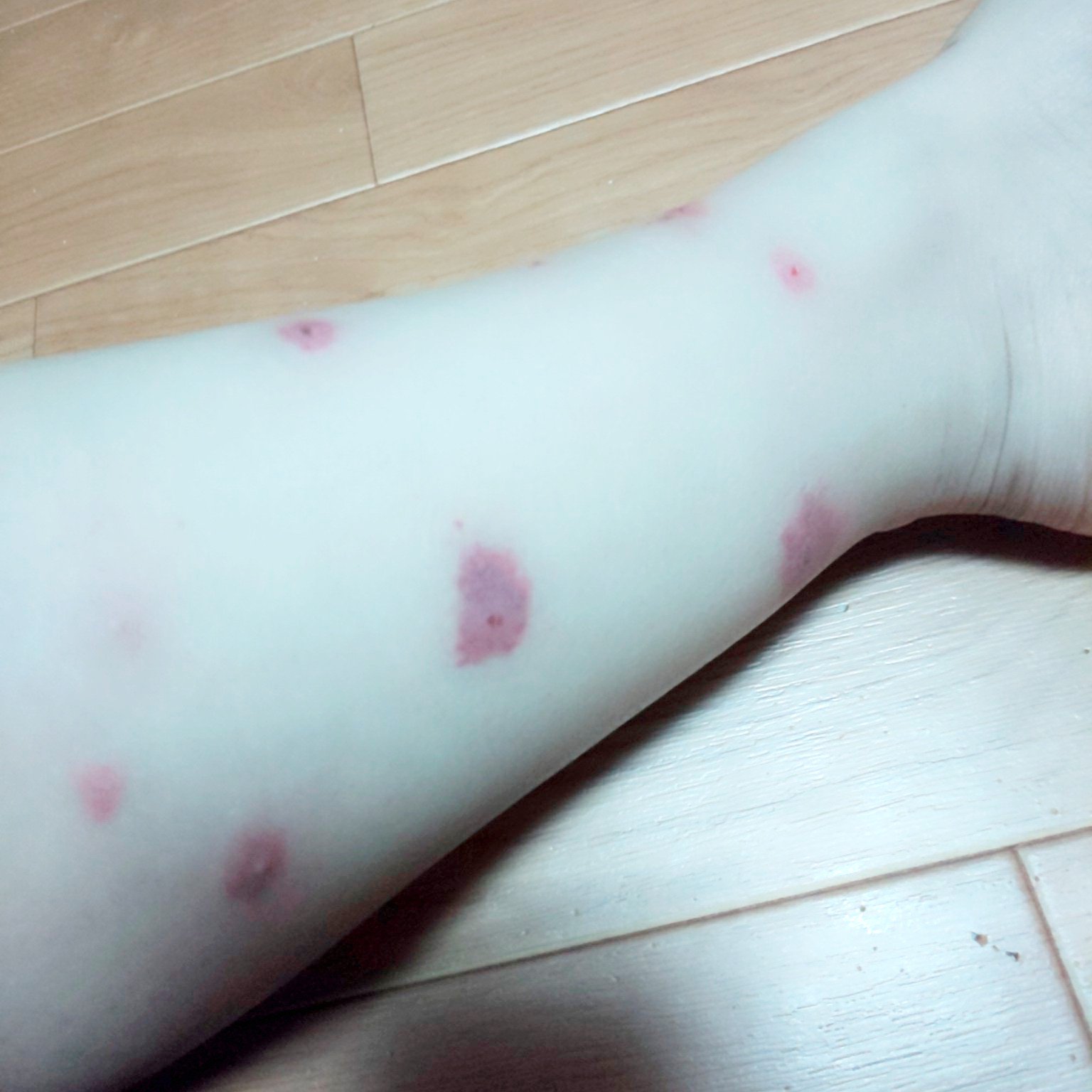 比奈 萌えボ 皮膚科に行ってきました たくさん虫刺されがあり状態も酷いらしく 治るのに時間が掛かるみたいです 数えたら手足で箇所 眠れないわけですね 処方されたお薬で治します T Co Pfyn0epdnr Twitter