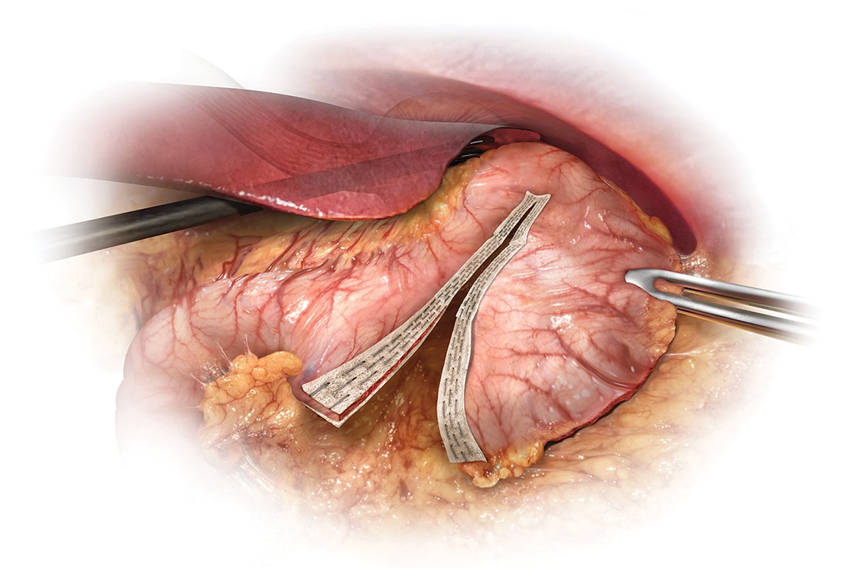 Staple line reinforcement in a  sleeve gastrectomy decreases rate of bleeding and reoperations - New analysis from MBSAQIP data (<a href="/SOARD_JOURNAL/">SOARD Journal</a> online) soard.org/article/S1550-… <a href="/asmbs/">ASMBS</a> <a href="/IfsoSecretariat/">IFSO</a> <a href="/WLGore/">Gore</a>