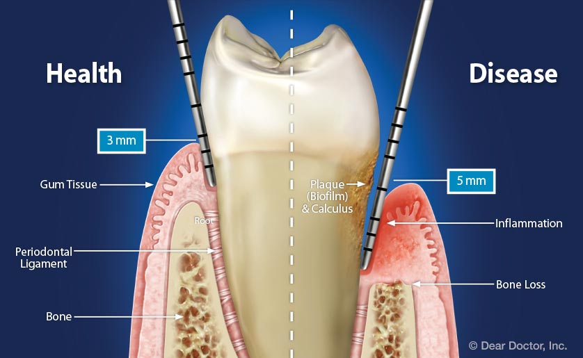 JoralHealth's tweet photo. #Gingivalpockets #Scurvy #Dentalcaries #Pyorrhea https://t.co/LPWazLsB8k