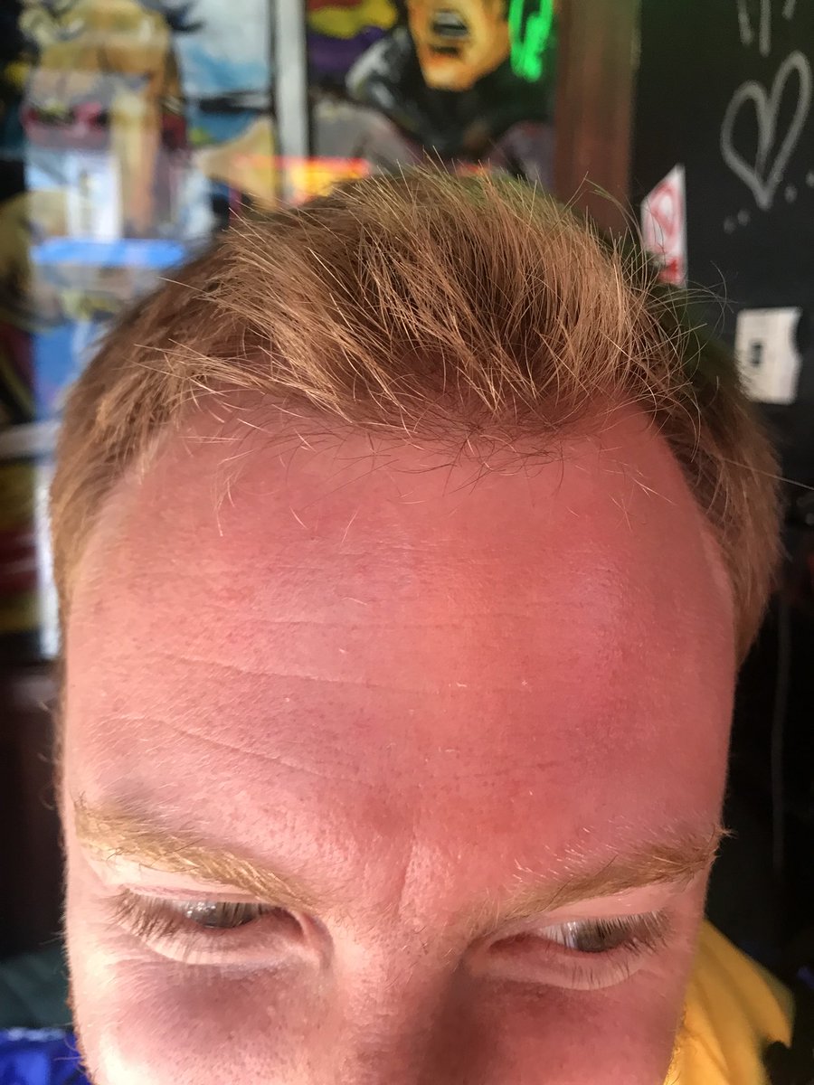 finto35's tweet photo. We thought of everything except the sun cream #t4ts #PoorRobbie https://t.co/rFr3uLNHy2