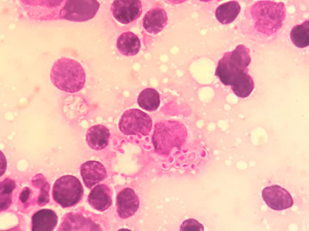 Histoplasmosis on bone marrow aspirate.