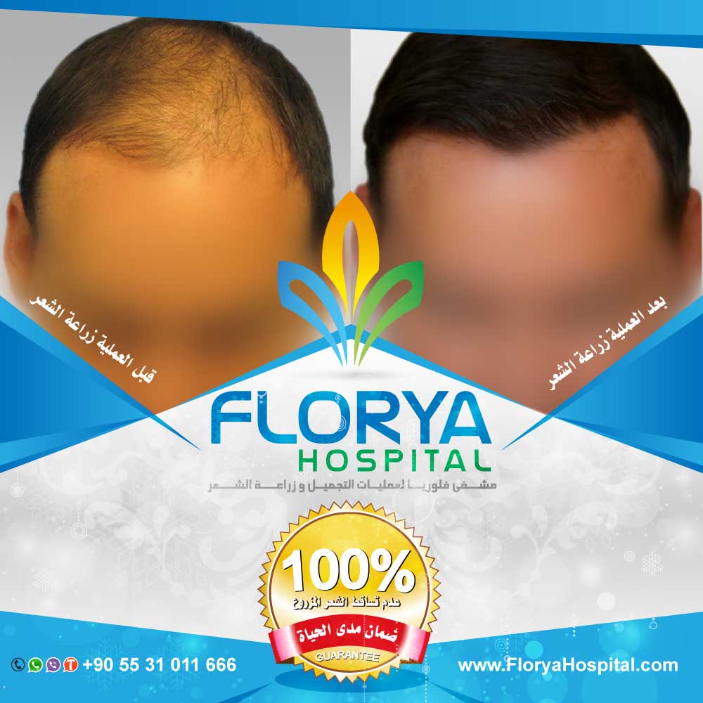 #زراعة_الشعر
أفضل اطباء تركيا في زراعة الشعر بأحدث التقنيات DHI , FUE و الروبوت.

قبل وبعد عمليات زراعة الشعر في تركيا.

#البرازيل_بلجيكا / نصف النهايي

احجز الأن:
☎️ 00905531011666
تعرف على افضل التقنيات المسخدمة من خلال زيارتك لموقعنا
FloryaCenter.com