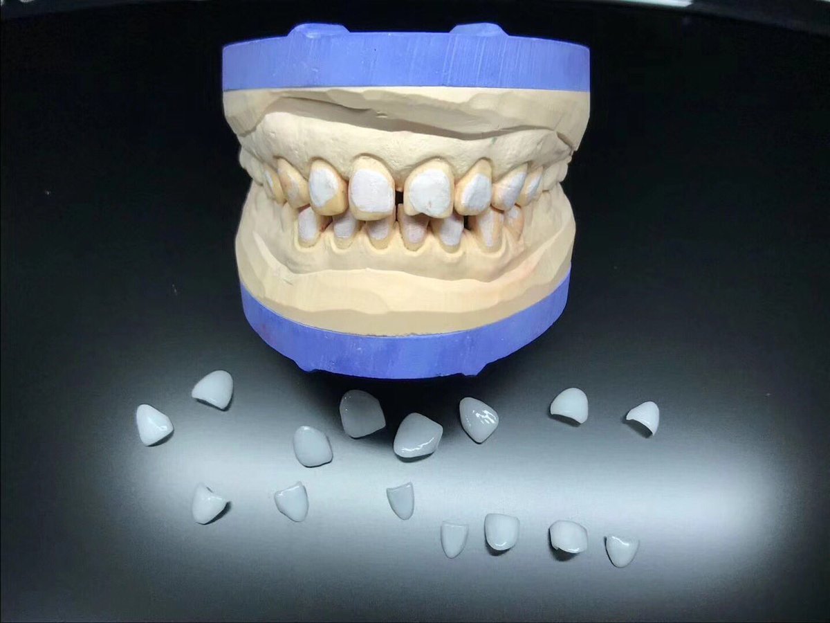 TOP_dentallab's tweet photo. Veneer work by us from TOP Dental Lab in Shenzhen China ❤️if you need any outsourcing service from us, contact me😉 #topdentallab #topdental #veneers #veneer #allceramic #dentallab #dentaltechnician #prothetics #anterior #falseteeth #denture #dentist https://t.co/VS2jS1XxDJ