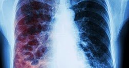 secretsofaidsa1's tweet image. HOW ACCIDENTAL TUBERCULOSIS VIRUS RELEASE LEADS TO EVACUATION IN AMERICA buff.ly/2MY4jsn