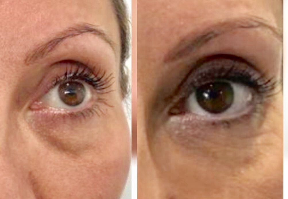 RenewMedClinic's tweet photo. Dark circles, under-eye bags, raccoon eyes... wave goodbye to the darkened area of thin skin right below the eyes with our #TearThrough treatment! ๐๐
Call 0330 111 8547 to book your FREE consultation! โ๏ธโ๏ธ #SkinExperts https://t.co/7Tw5myDai3