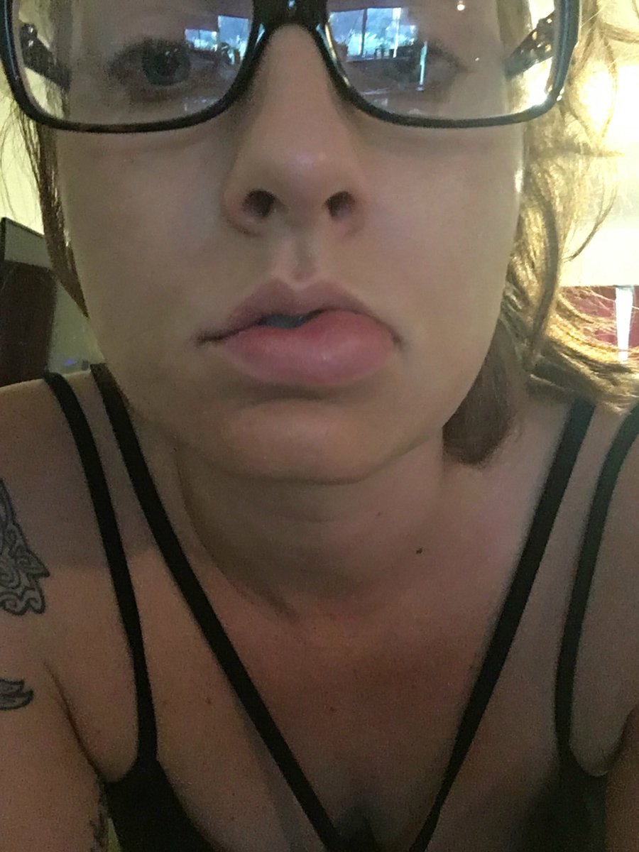 SGrimoire's tweet photo. Allergic reaction? Infection? Rare insect bite? Your guess is as good qualified medical professionals! Sorry for being so hard to reach lately. https://t.co/uVglA3F004