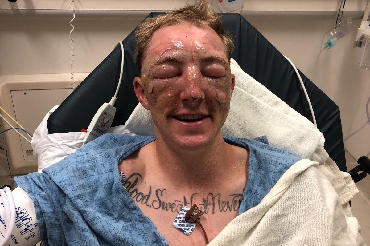 Firefighter Brandon Feller-Recovery Fund. His engine was burned over this week at the #KlamathonFire , he has severe burns. He was flown to and remains at UC Davis ICU Burn Center.  
gofundme.com/brandon-feller… <a href="/CALFIRE_PIO/">CAL FIRE PIO</a> #Calfire #firefighter #burned