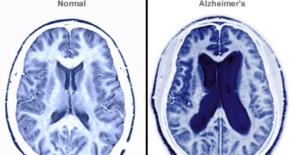 MedscapeNeuro's tweet image. A radical new definition for Alzheimer’s: ms.spr.ly/6012r4RAi