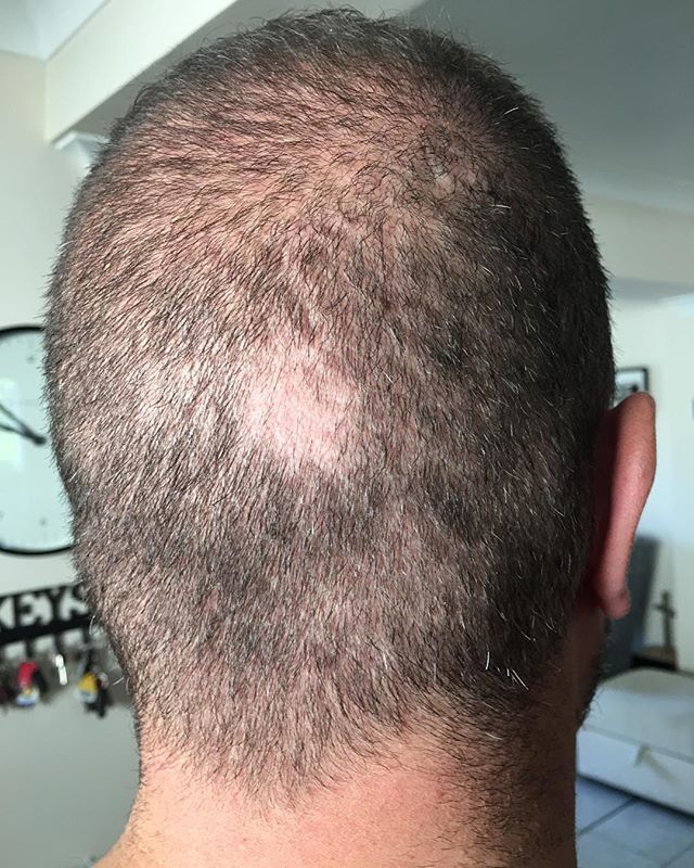 Nearly 3 weeks after #radiationtherapy my hair decides to fall out!!!! @braintumourrsch @wessexcancertrust @uhsft ift.tt/2ueR2Ei