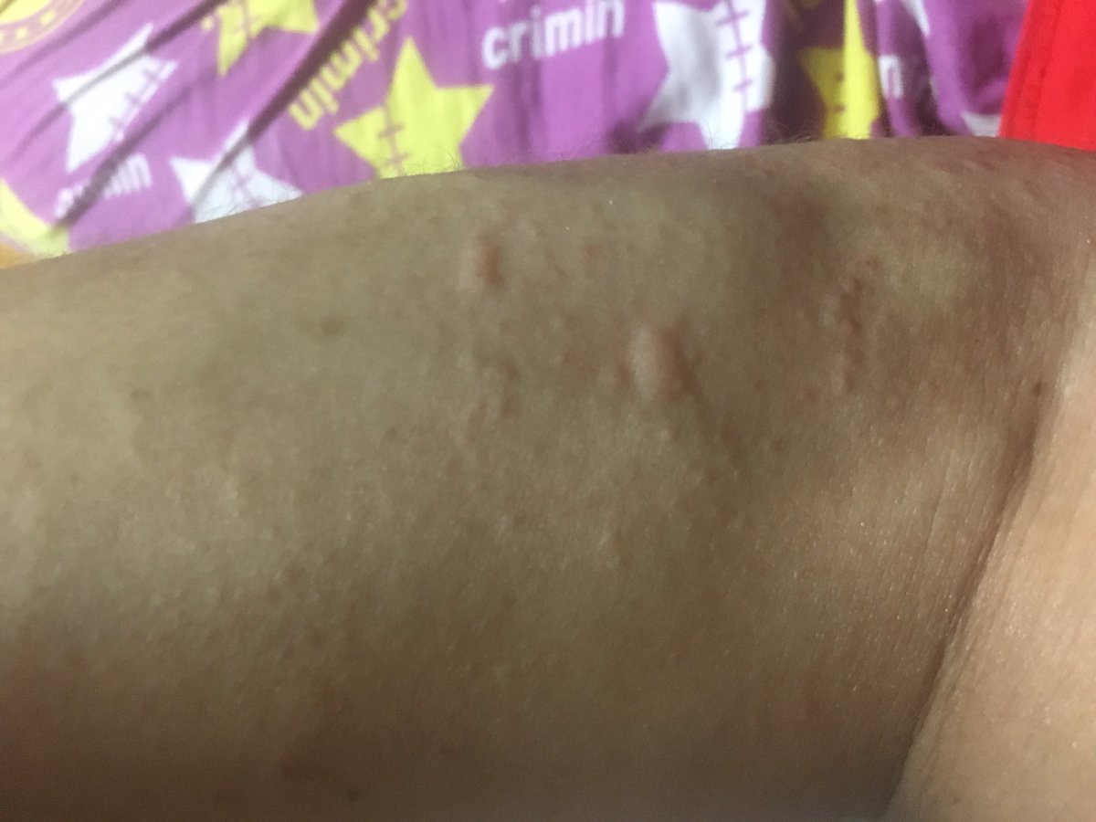 ひぐらしなまず アクアリウム בטוויטר 今日は草をかき分けて釣りしてたので 腕に謎のブツブツが めちゃくちゃ痒いです 毛虫か 草にかぶれたかですね ひぐらしなまず アクアリウム בטוויטר 今日は草をかき分けて釣りしてたので 腕に謎のブツブツが めちゃくちゃ痒いです 毛虫か 草にかぶれたかですね