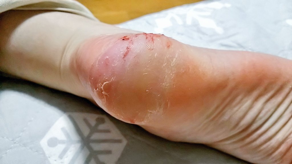 うめさく かかとの皮を剥く癖をやめたい 痛いのについやってしまう 閲覧注意 T Co 45l2br2vzh Twitter