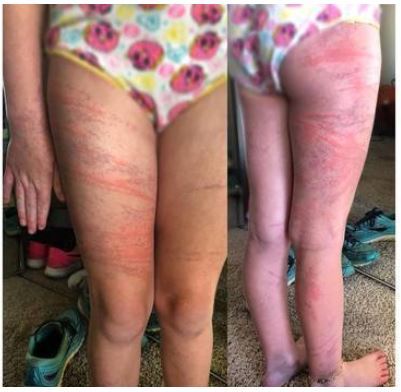 Mother says 7-year-old hurt by Portuguese Man O’ War dailynews24h.net/mother-says-7-…