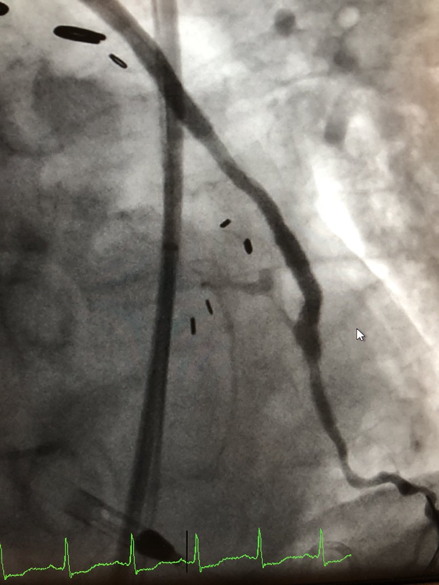 87 y/o nstemi and cardiac arrest - Cath shows SVG unknown time of occlusion but looked fresh. Penumbra cleaned out and facilitated stents, Impella since renal disease and needed LAD work too.#penumbra#indigo#CatRX#thrombectomy#impella#HRPCI