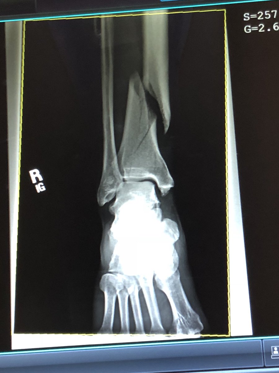 adrpdaclab's tweet image. Why 40 year old uncoordinated men should never roller skate in pictures #tibfib #nicefractures #westhoustonhospital #theregoesmynflcareer