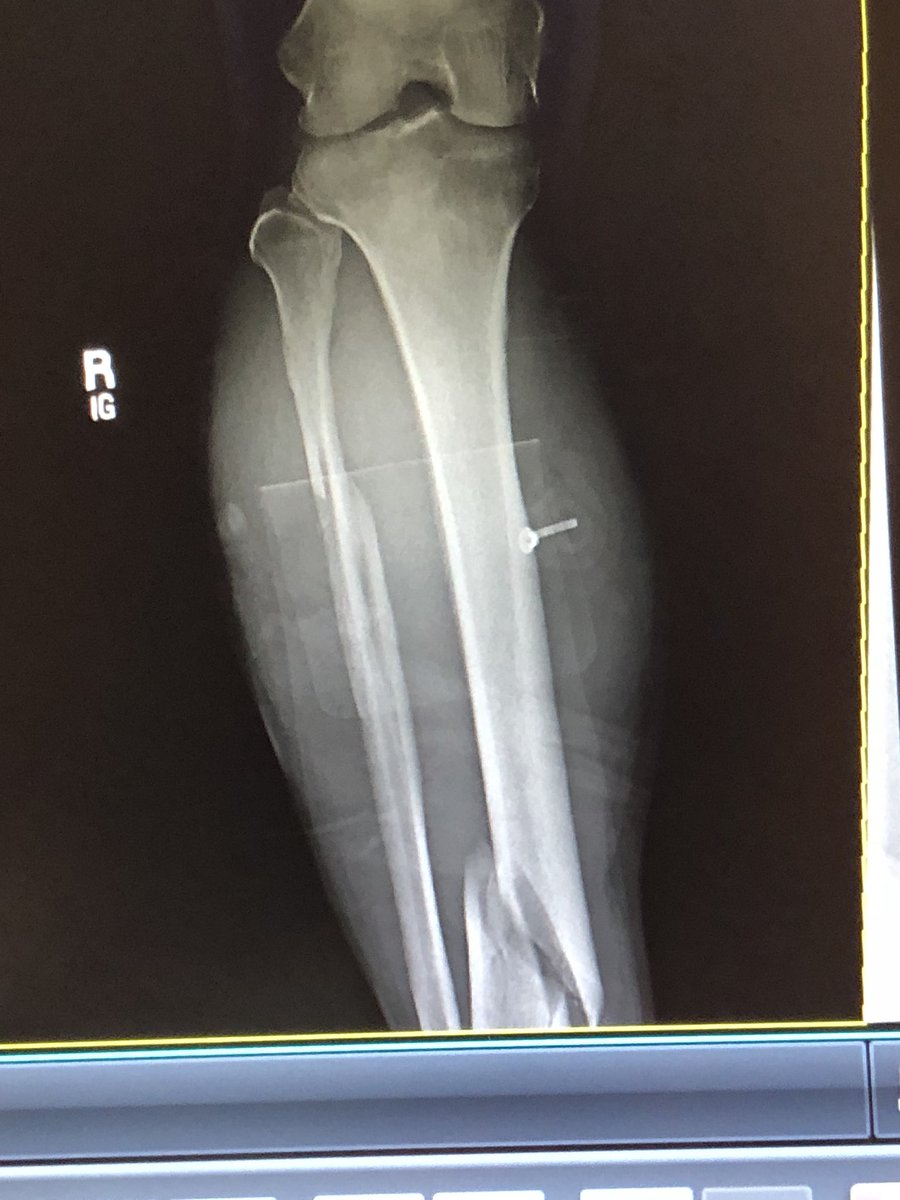 adrpdaclab's tweet image. Why 40 year old uncoordinated men should never roller skate in pictures #tibfib #nicefractures #westhoustonhospital #theregoesmynflcareer