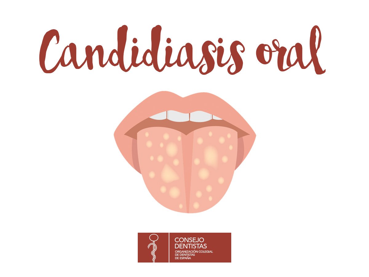 que es candidiasis en la cavidad oral