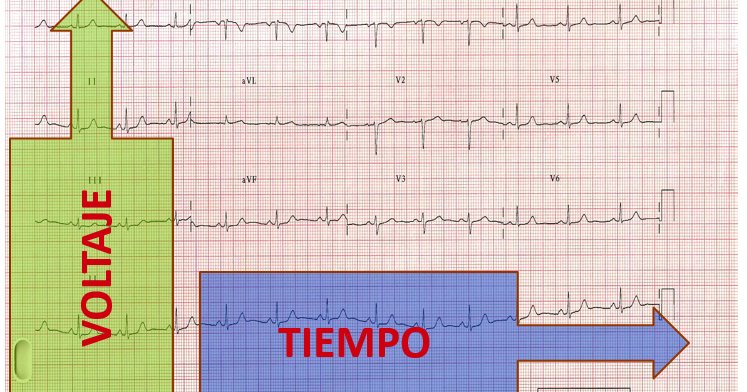 urgenciasemerge's tweet photo. #RememberPost 👉 Lo básico en calibración del #electrocardiograma https://t.co/zmODFIUG0W
〰️〰️〰️
#FOANed #FOAMed #FOAMem #urgencias #emergencias #urgenciasyemergencias #electrocardiografía #EKGTips #ECGTips #ecg #ekg #cardiología #voltaje #calibración https://t.co/RuBpHHZprL