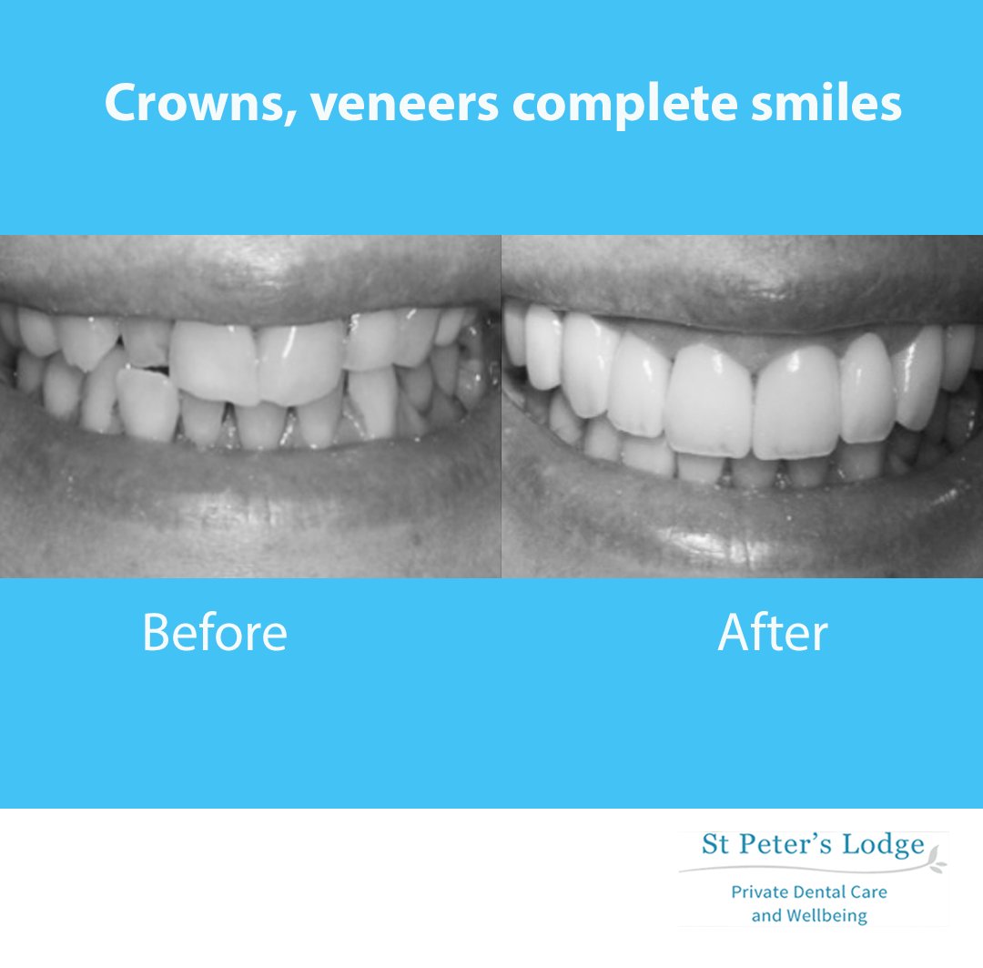 Choosing crowns and vaneers - We are helping patients daily to improve their confidence and transform their smiles!
#dentist #stalbans #smile #transformingsmiles