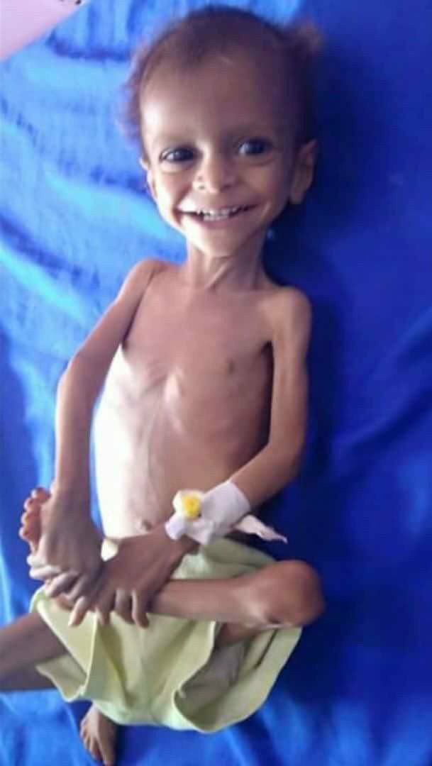 AhmadAlgohbary's tweet photo. I am so happy that the world comes together to save boys trapped in cave in #Thailand. But why they can't do it to save 2 million children from malnutrition in #Yemen?
My country is forgotten, why is that?
Are we human beings?
Do we deserve to live in peace?
My heart is broken. https://t.co/y0UbJz56Ji