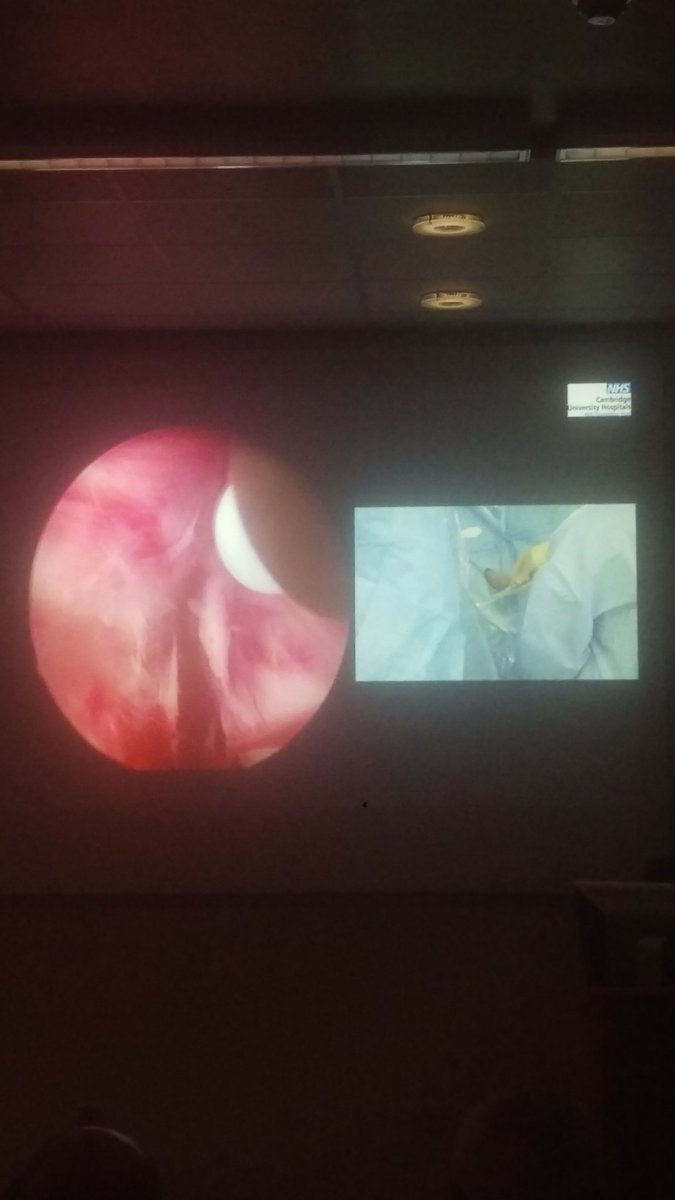 AdhamAhmedUro's tweet photo. Expert HoLEP tips and tricks from @drtevaho Start the learning curve with the trilobar technique that gives you 3 surgical landmarks at 5,7 and 12 o'clock. Nice blanching effect, though, with #MOSESTechnology
@CamUrology @CUH_NHS @ProstateCambrdg @LumenisU https://t.co/ULWCnjux5k