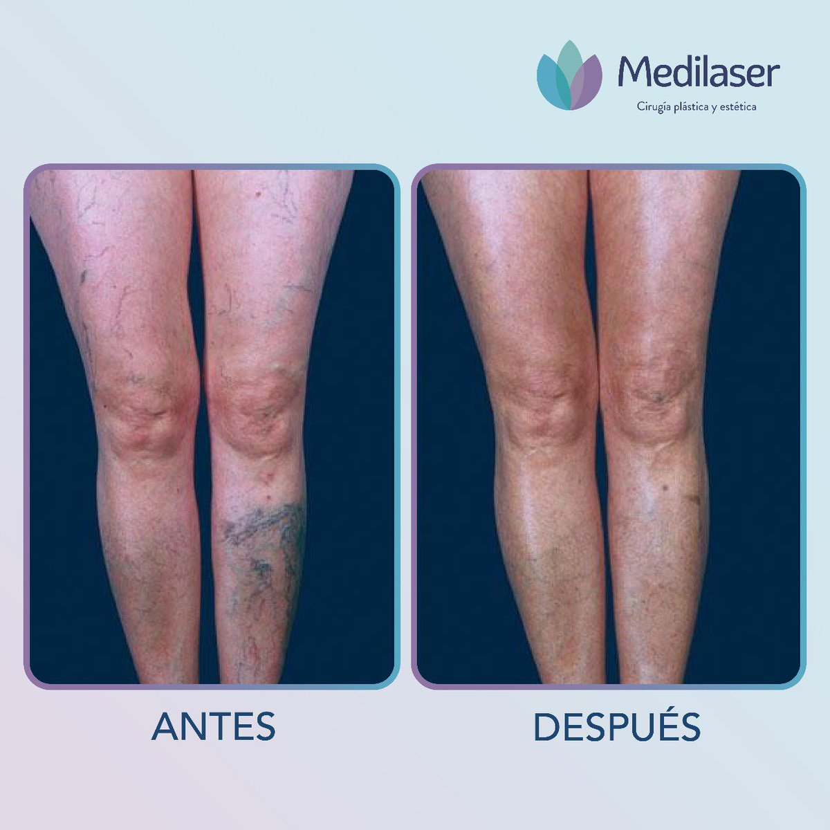 medilasermx's tweet photo. Un problema de várices que no es tratado de forma correcta ocasiona severos daños en la salud.

No pongas en riesgo tu salud, agenda una cita de valoración al 5536854545.

Somos líderes en remoción de várices.🎁💅 https://t.co/KvP98ZBBju