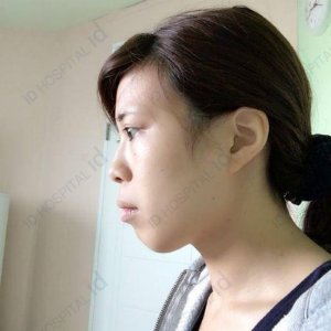 ナビコリア 韓国美容整形 無料サポート 韓国整形エージェント Since08 横顔美人 の彼女もパク サンフン先生で両顎手術を受けていました パク先生のカウンセリング会は8月 東京銀座院でのカウンセリング会になります レントゲン撮影等も可能です