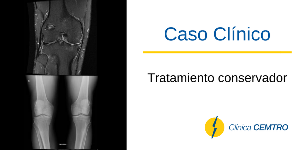 ClinicaCEMTRO's tweet photo. 🔙 #CasoClinico | Se cree que por la edad es un poco tarde para la osteotomía valgizante, y aunque también se propone #protesis #unicompartimental, parece que el dolor no es tan intenso ni incapacitante y finalmente se opta por tratamiento conservador https://t.co/Ro3TSJgde9