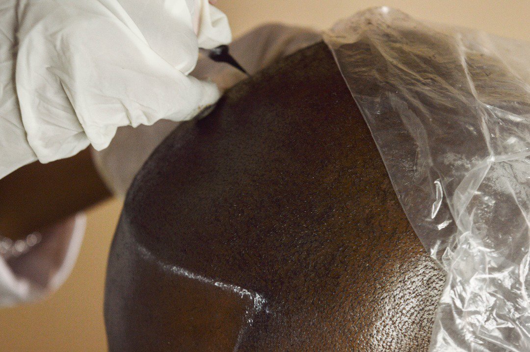 VinciHairNG's tweet image. #Msp #microscalppigmentation 
Call 09071681615 or DM to book a Free consultation.