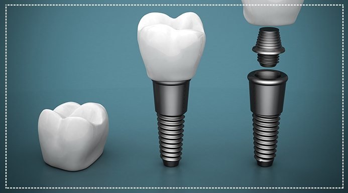MYFamilyDentist's tweet image. Find out if #dentalimplants are the right solution for you to rebuild a healthy, natural-looking smile. buff.ly/2Fs3NzQ