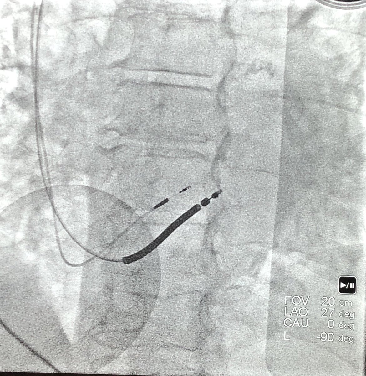 Sheath in sheath for HIS bundle lead with severe RA enlargement. Thank you @gopi_gdanda1