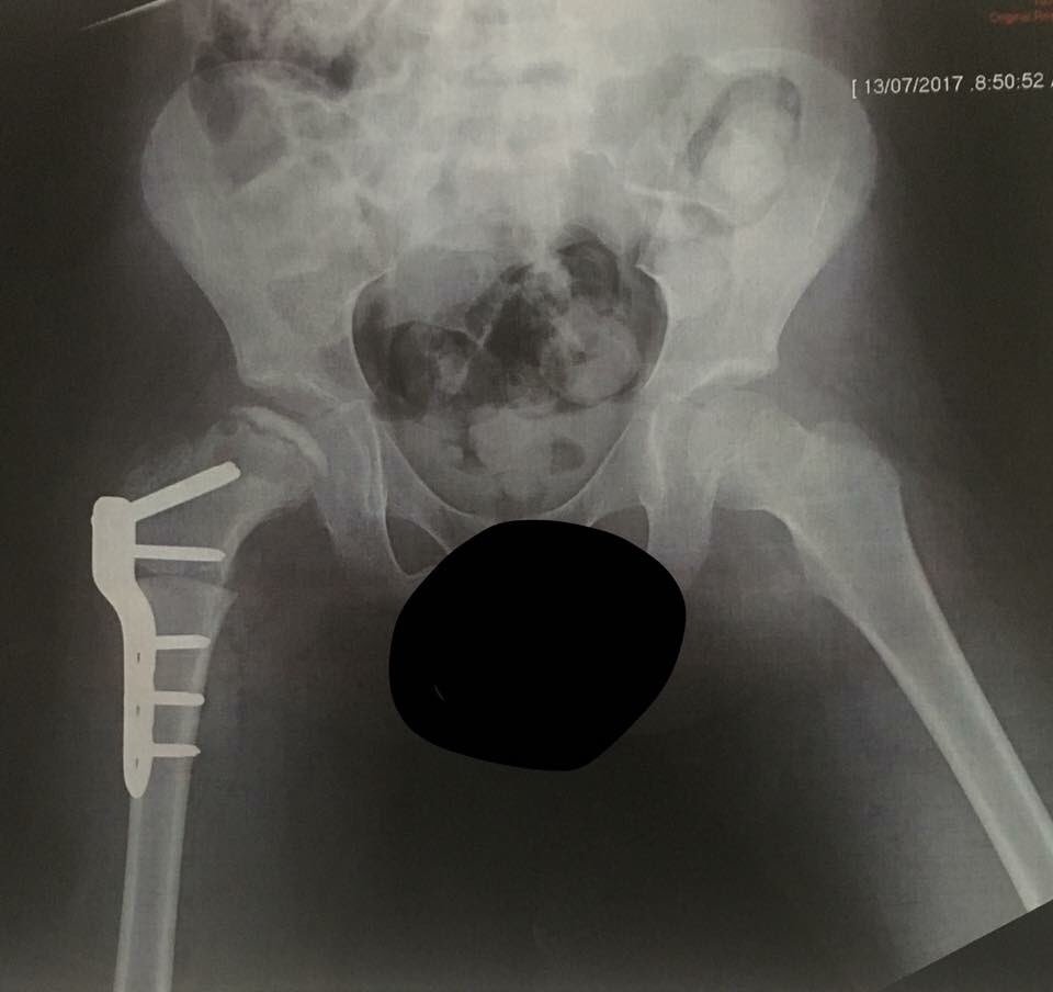 nathGCU's tweet photo. After 12 months with a metal plate and screws in, today is the day our #Pertheswarrior gets it out. Still 18 months of recovery to go but a big step. #hipcondition #perthesdisease https://t.co/lm7yVNdWPy