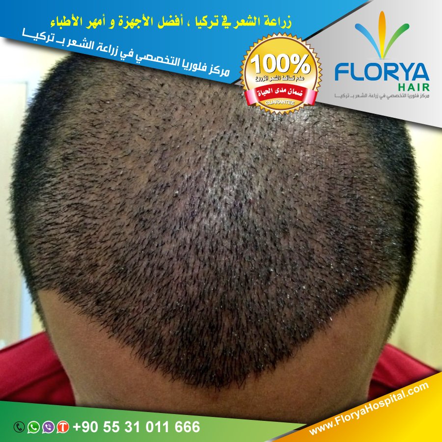 أفضل اطباء تركيا في #عمليات_التجميل و #زراعة_الشعر

خصم 200$ على جميع زراعة الشعر خلال هذا الشهر

#احلي_ماقيل_فالغزل

للاستشارة المجانية:
☎️ 00905531011666
تعرف على افضل التقنيات المسخدمة في مشفانا من خلال زيارتك لموقعنا.
FloryaCenter.com