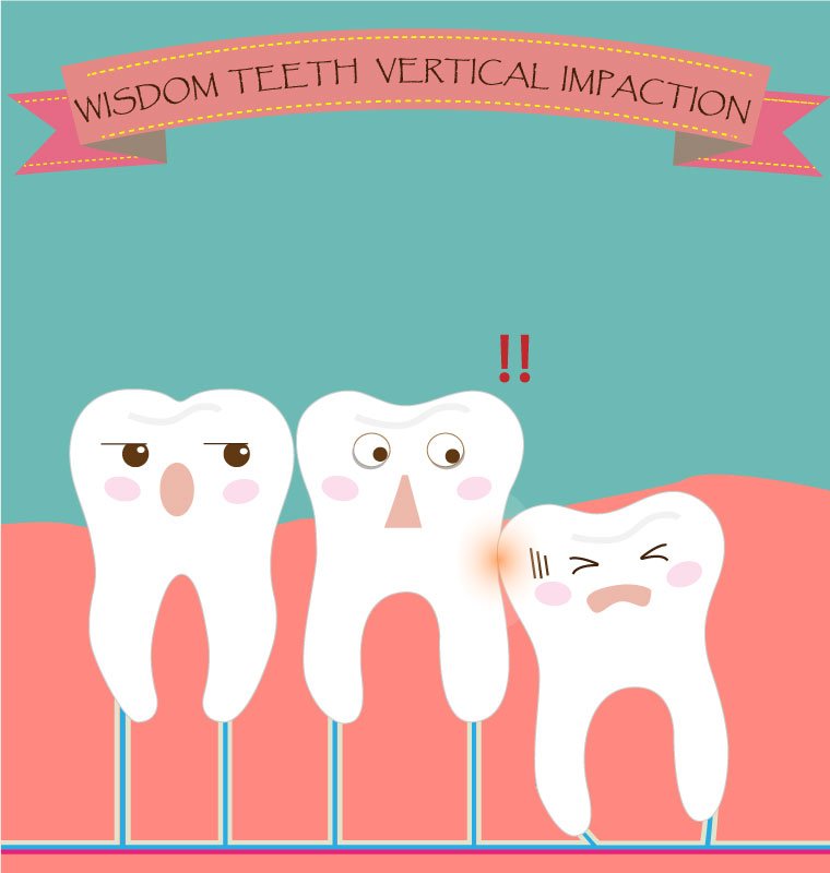 Wisdom teeth are the most frequently removed kind of tooth, and for good reason. They have a high likelihood of causing dental diseases, including: IMPACTION.
Wisdom teeth can become impacted, meaning they never erupted completely, causing inflammation, as well as infection.