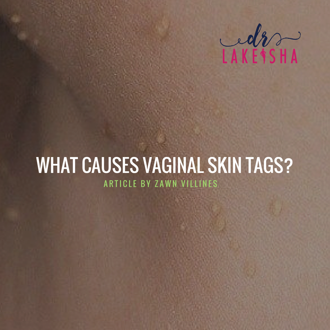 Vaginal Skin Tag vaginal-skin-tag