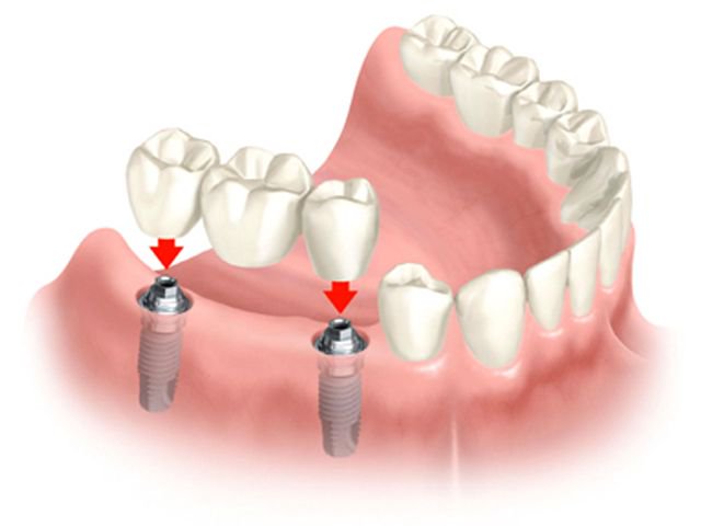 Are you looking for an alternative to the dentures?
There are two other ways missing teeth can be replaced -- with bridges and implants.
Know more about both: buff.ly/2H98ymN
