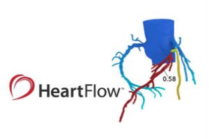 BCloudUK's tweet photo. CAD kills more people than cancer in the US. Now unicorn health disrupter @HeartFlow is set to make an impact in the #NHS with its revolutionary detection tech https://t.co/h2XO34Koyu https://t.co/ofdJwBJOqe